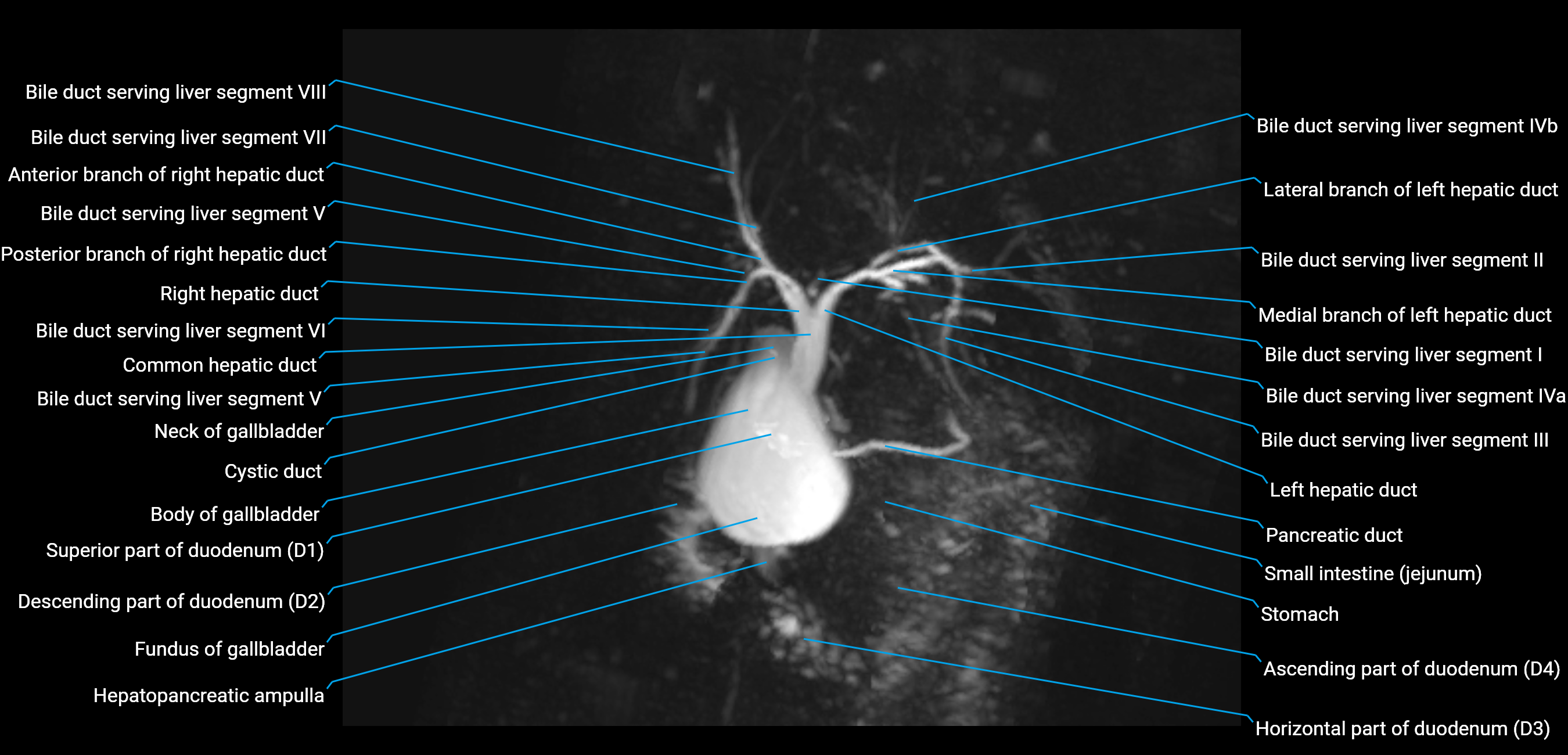 MRCP MIP MRI  anatomy labelled image-img-01003-00017.png